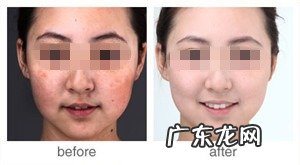 激光祛斑疼吗要多长时间 激光祛斑疼吗用麻醉吗