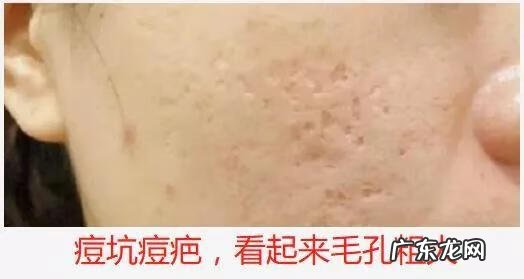 怎么样才能收缩脸上的毛孔 怎么收缩面部毛孔?