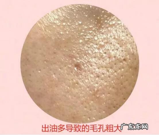 怎么样才能收缩脸上的毛孔 怎么收缩面部毛孔?