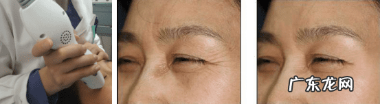 去鱼尾纹 鱼尾纹怎么去除