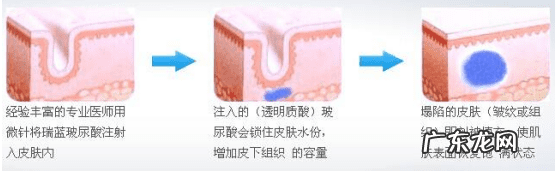 去鱼尾纹 鱼尾纹怎么去除