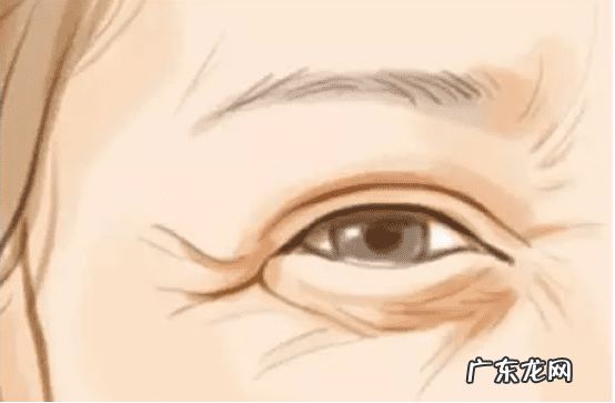 去鱼尾纹 鱼尾纹怎么去除