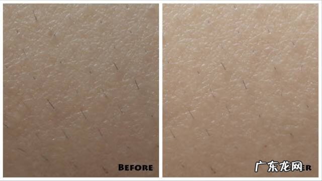 如何永久脱毛不再长 怎样才能永久脱毛