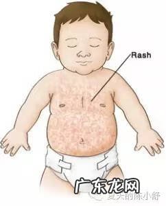 幼儿急疹的症状图片 幼儿急疹的症状和表现