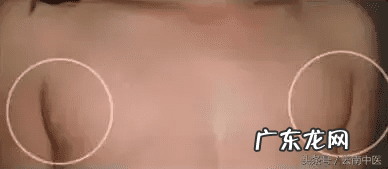 耳朵里面长了一个包 耳朵后面长包是什么原因