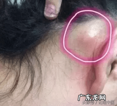 耳朵里面长了一个包 耳朵后面长包是什么原因