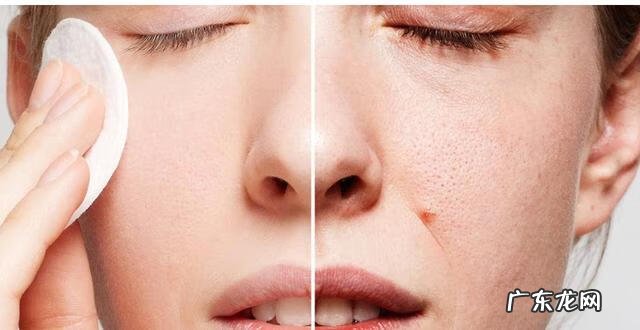 如何解决毛孔粗大的问题 怎么解决毛孔粗大?