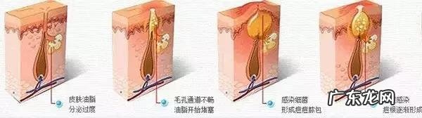 如何快速去除痘痘和痘印 怎么快速去掉痘痕