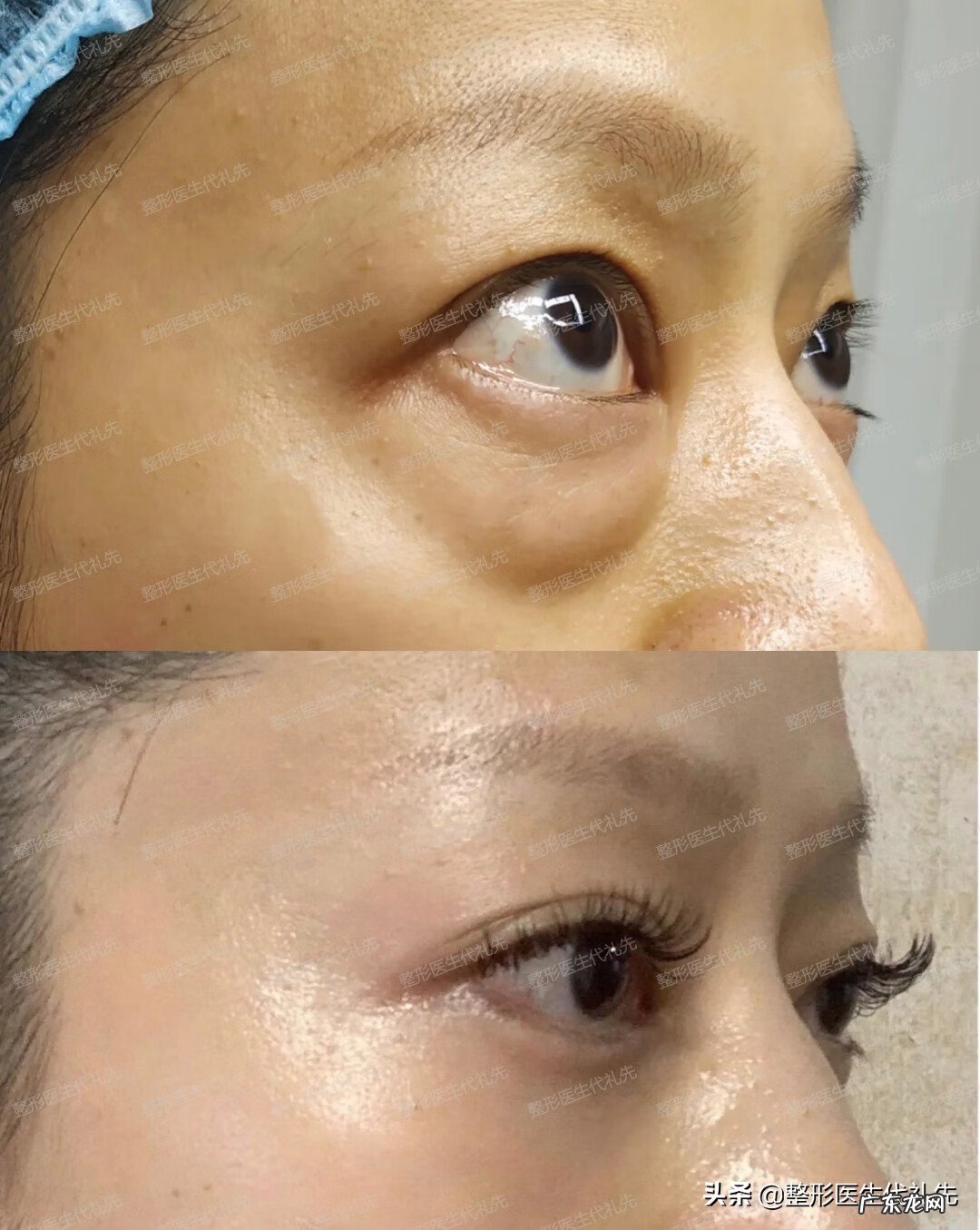 眼袋越来越大是什么原因 眼袋大是什么原因?