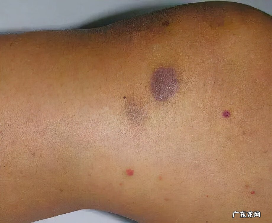 什么样的发烧是白血病 什么是白血病早期症状