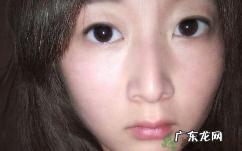 鼻子周围发红有红血丝 鼻子周围红血丝明显