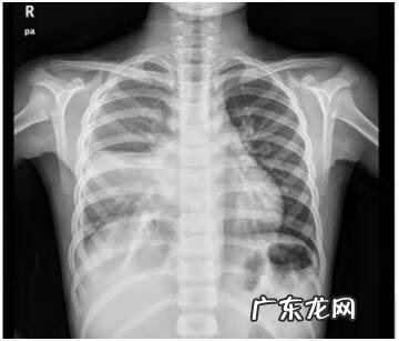 支原体阳性的症状表现 肺炎支原体抗体1:40