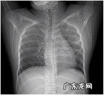 支原体阳性的症状表现 肺炎支原体抗体1:40