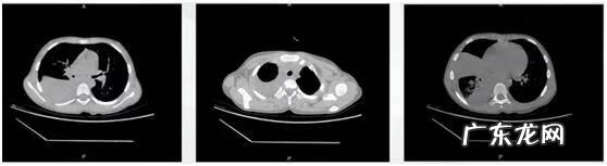 支原体阳性的症状表现 肺炎支原体抗体1:40