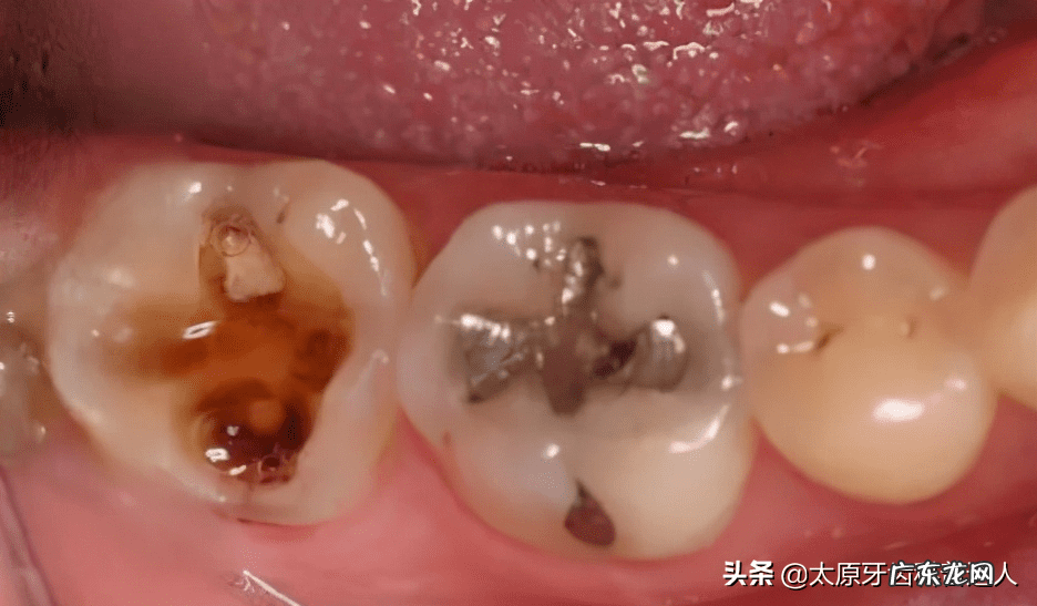 虫牙里面有虫吗 虫牙是真的有虫子吗