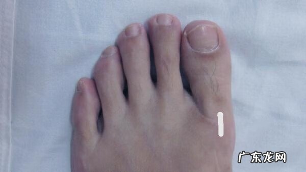 脚趾头旁边长了个硬疙瘩 脚趾头上长硬疙瘩是怎么回事