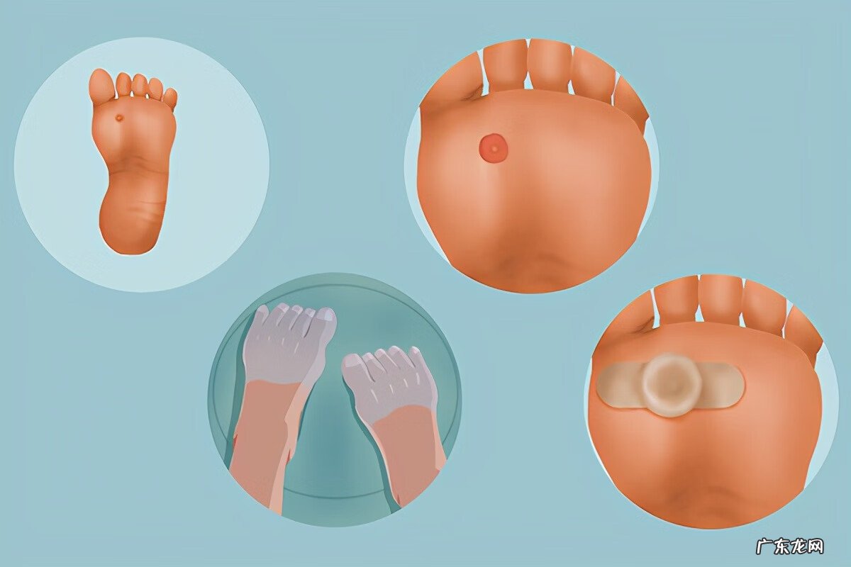 脚上长了鸡眼怎么处理 脚上有鸡眼怎么办呢