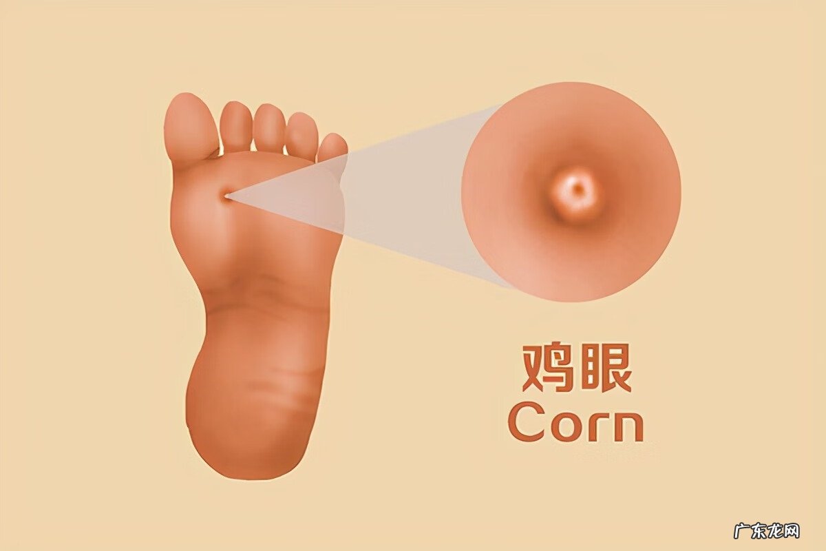 脚上长了鸡眼怎么处理 脚上有鸡眼怎么办呢