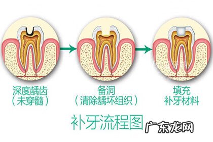 门牙蛀牙可以修复吗 门牙蛀牙怎么办