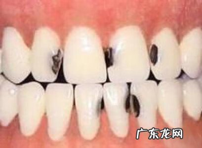 门牙蛀牙可以修复吗 门牙蛀牙怎么办