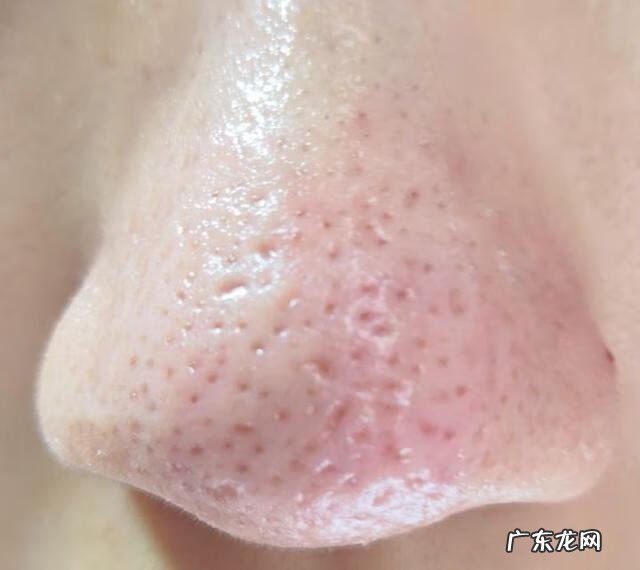 毛孔粗大为什么 毛孔特别粗大怎么回事