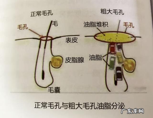 毛孔粗大为什么 毛孔特别粗大怎么回事