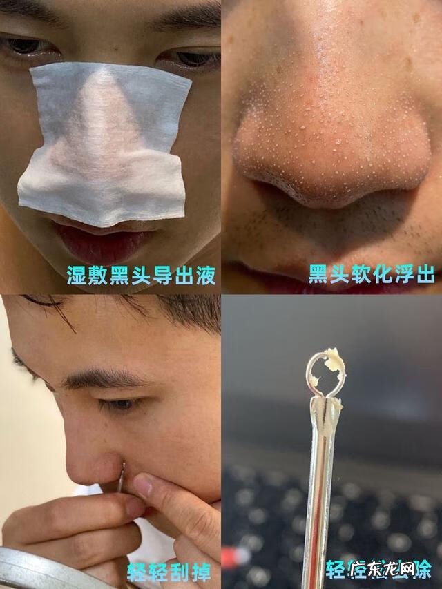 毛孔粗大为什么 毛孔特别粗大怎么回事