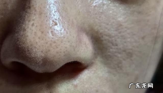 毛孔粗大为什么 毛孔特别粗大怎么回事