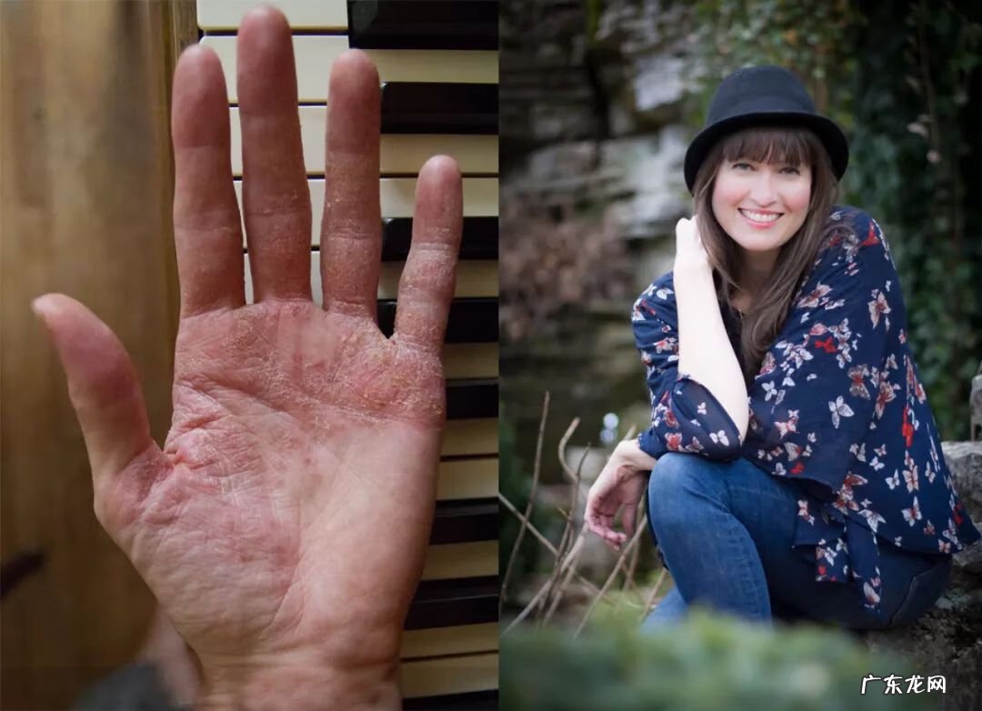 念珠菌用什么药效果好 念珠菌用什么药最好