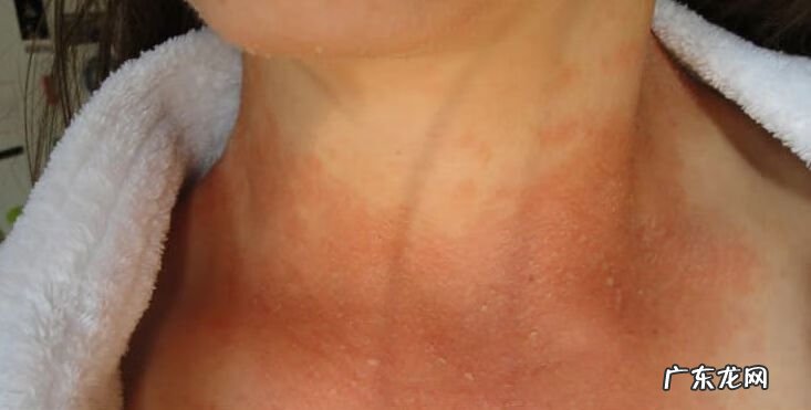 念珠菌用什么药效果好 念珠菌用什么药最好