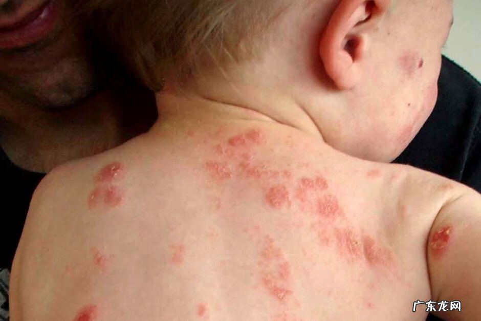 最有效治湿疹的偏方 儿童湿疹偏方