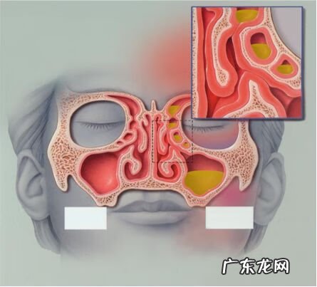 怎么判断是过敏性鼻炎 小儿过敏性鼻炎症状有哪些
