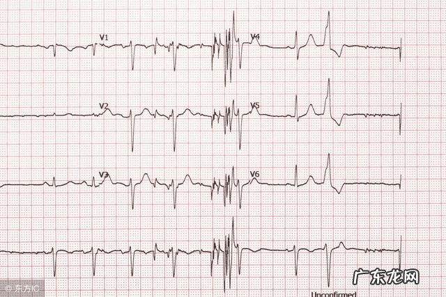 心房颤动心电图图片 心房颤动心电图表现