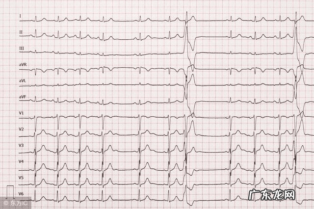 心房颤动心电图图片 心房颤动心电图表现