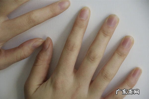 手指肿胀有7个原因 手指肿胀是什么问题