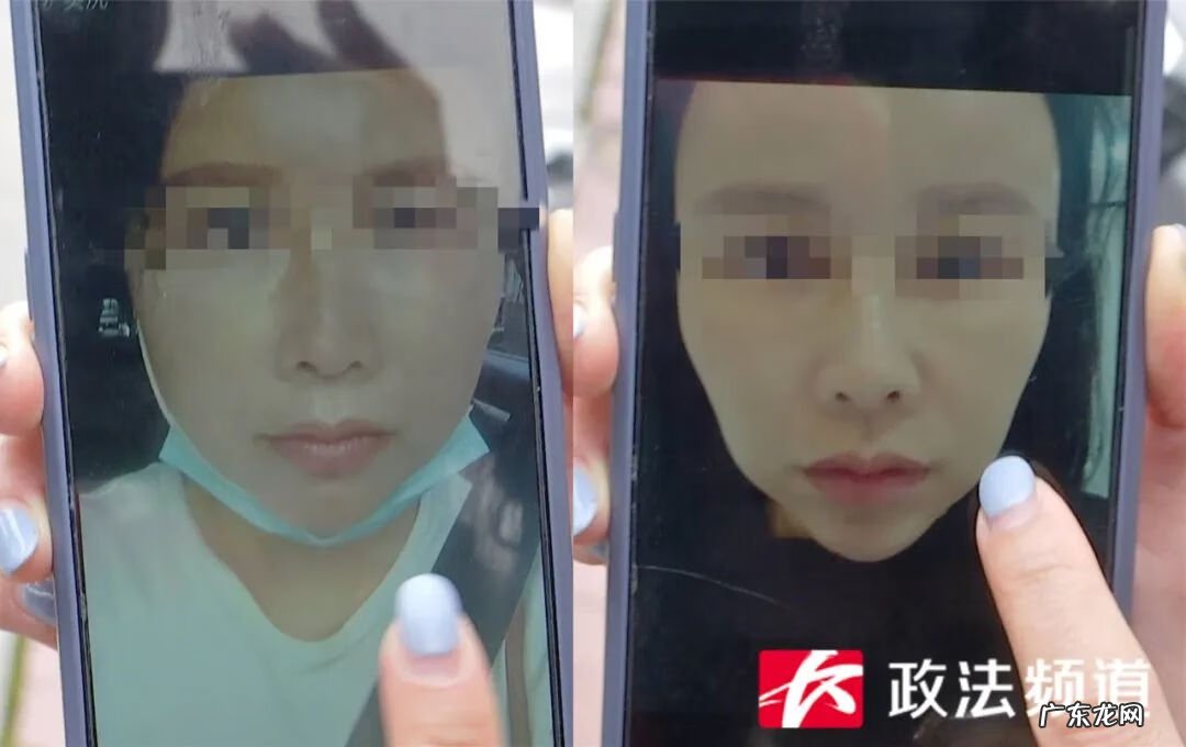 脸部整形大概需要多少钱 面部整形需要花多少钱