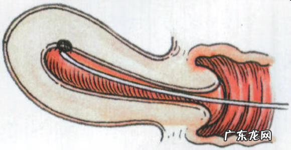 无痛人流多少钱费用 微管无痛人流价格