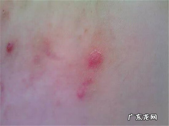 去除婴儿湿疹小妙招 婴儿湿疹图片