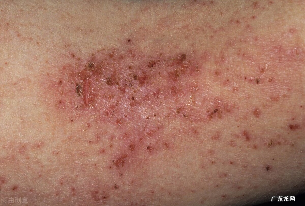 湿疹的最佳治疗方法 湿疹治疗