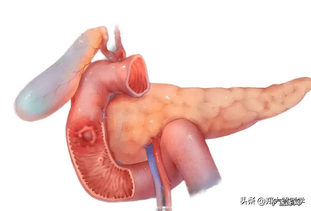 十二指肠息肉是怎么回事 十二指肠息肉