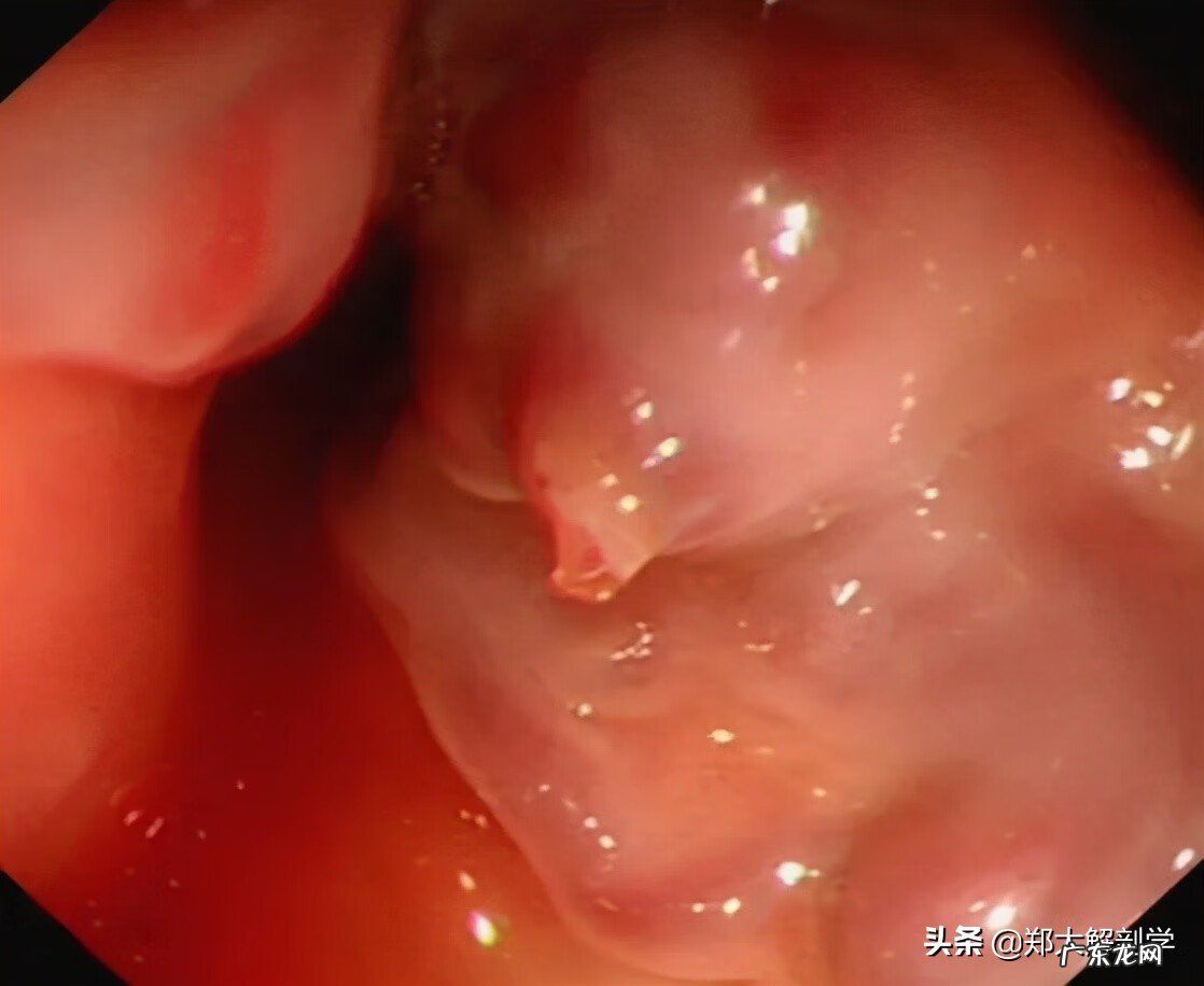 十二指肠息肉是怎么回事 十二指肠息肉