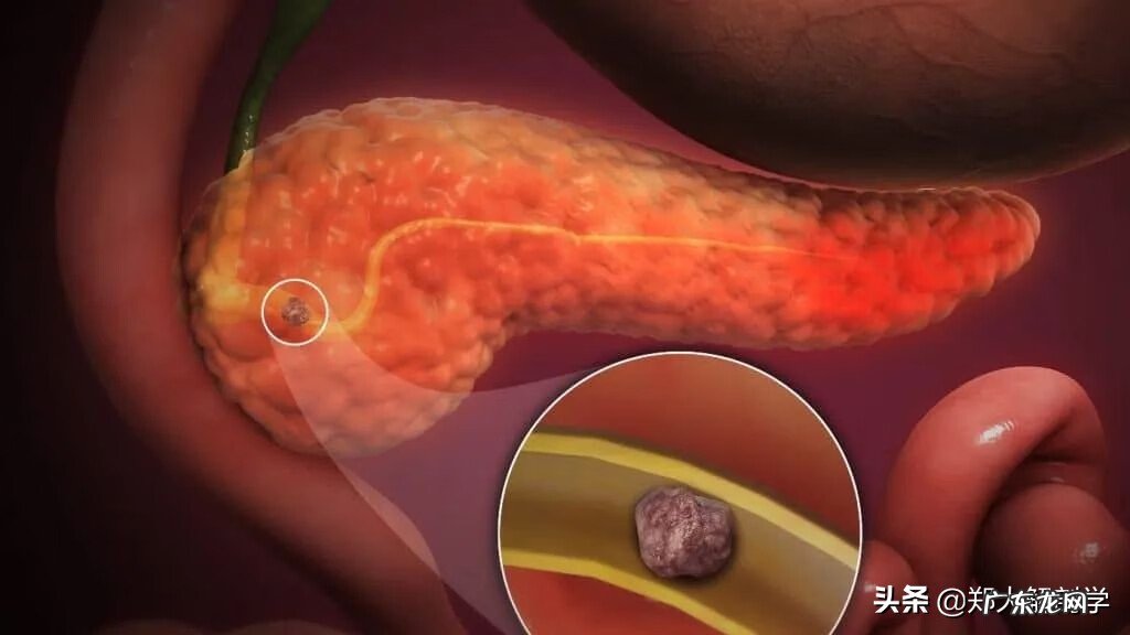 十二指肠息肉是怎么回事 十二指肠息肉