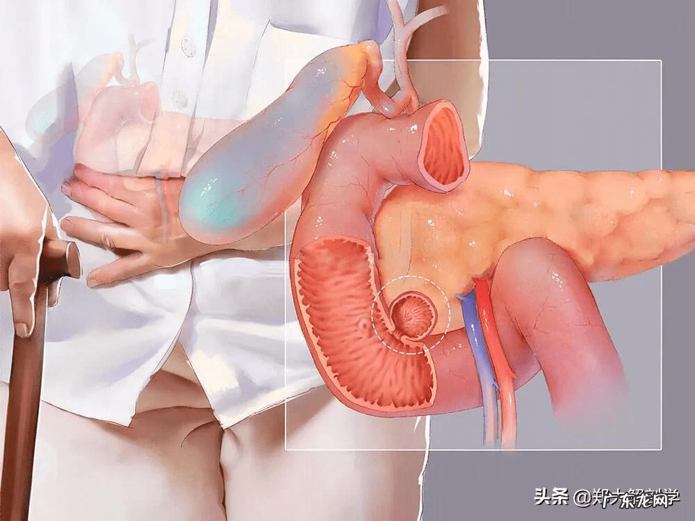 十二指肠息肉是怎么回事 十二指肠息肉