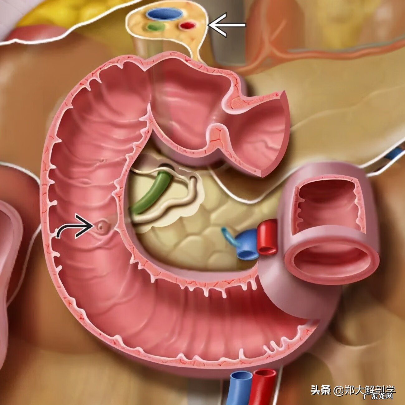 十二指肠息肉是怎么回事 十二指肠息肉
