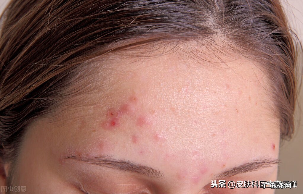 治疗痤疮最快最有效的方法 治疗痤疮最佳方法是什么