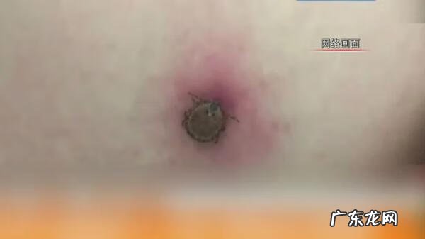 被蚊虫叮咬后红肿严重 脖子被蚊虫叮咬红肿怎么办