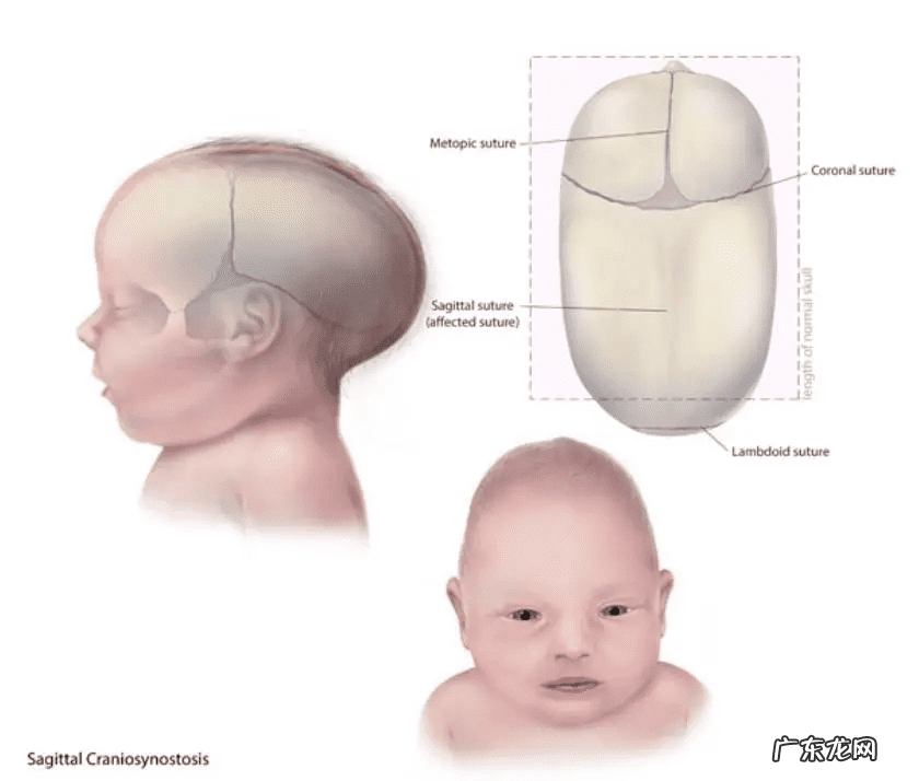 囟门大小标准 囟门小是怎么回事