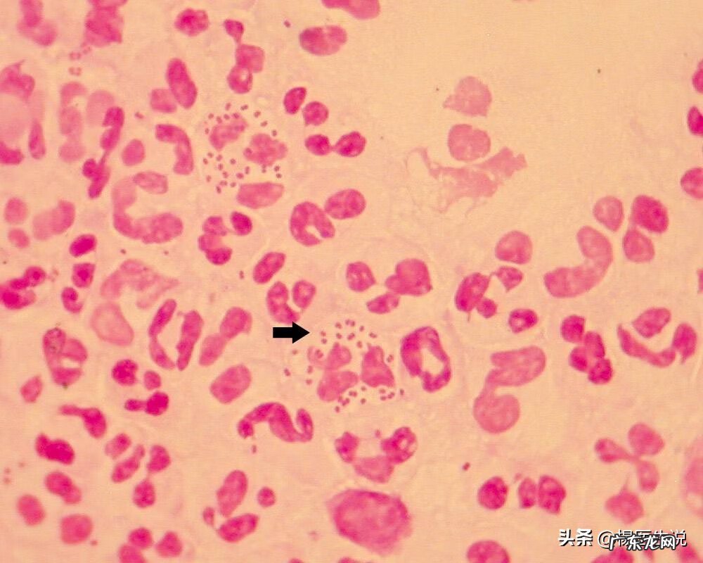 淋菌性尿道炎分泌物图片 淋菌性尿道炎是怎么感染的