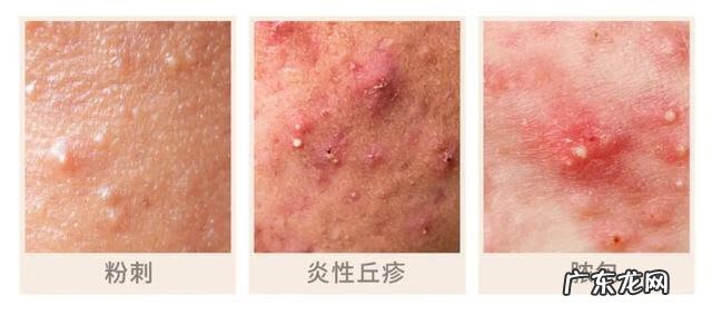 如何正确去痘痘 祛痘美白什么产品好