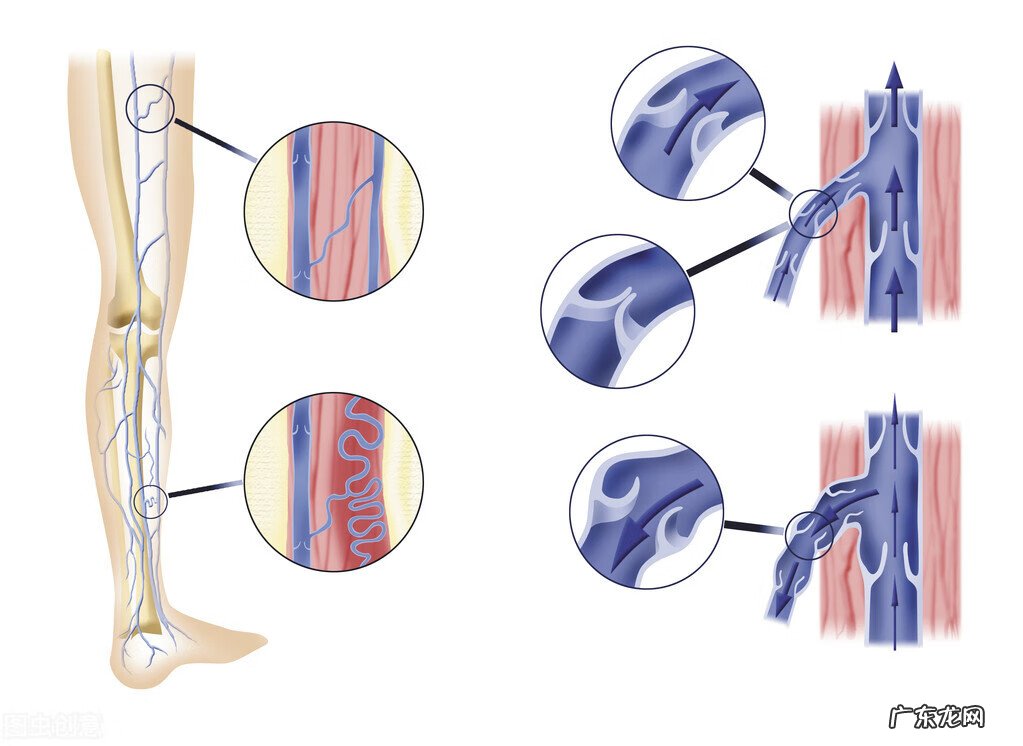 静脉曲张怎么治疗最佳方法 静脉曲张怎么治疗才能好
